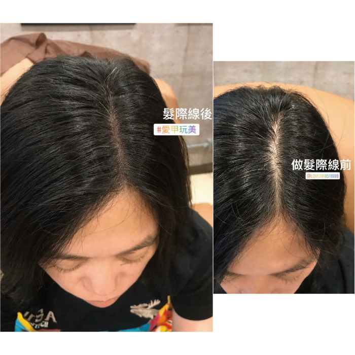 透過現今的紋繡技術,可以將髮際線自然填補, 讓你怎麼分邊都好看 髮際線推薦-台中髮際線推薦