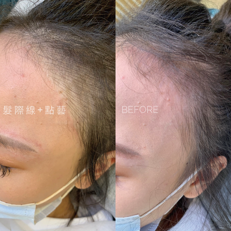 想要擁有完美的髮際線就到愛甲玩美,經由髮際線紋繡打造自然仿真毛流 髮際線推薦-台中髮際線推薦