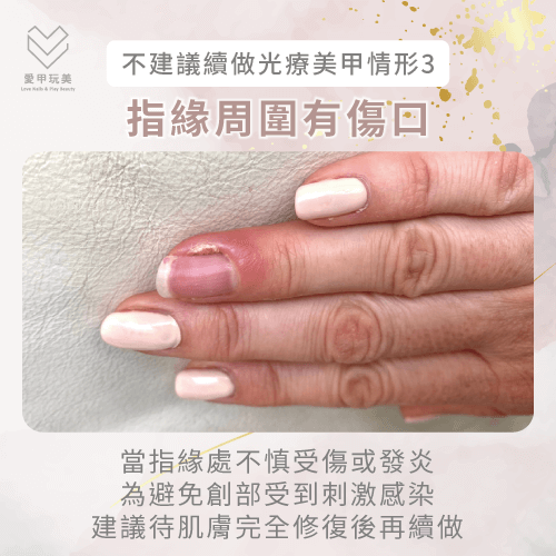 指緣受傷不建議續做光療指甲-光療指甲可以一直做嗎