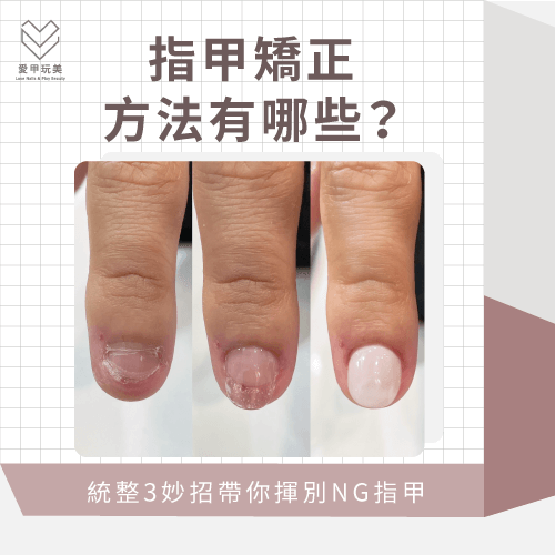指甲矯正的方法有哪些-指甲矯正方法-台中指甲矯正