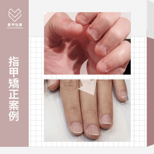 愛甲玩美指甲矯正案例分享-指甲形狀矯正-台中指甲矯正
