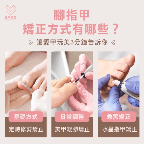 3個腳指甲矯正方式-腳指甲形狀-台中指甲矯正